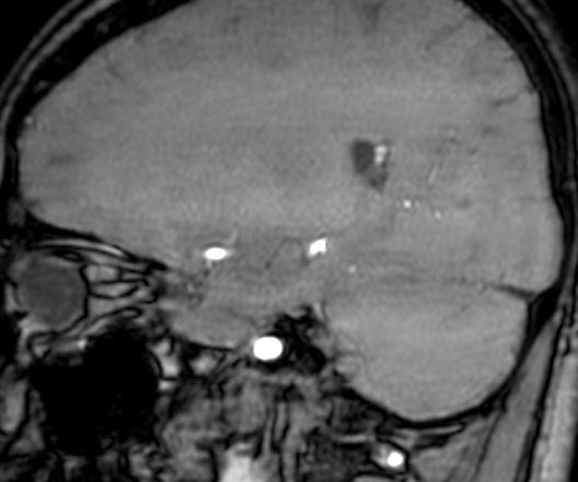 Cerebral arteriovenous malformation at posterior body of corpus callosum (Radiopaedia 74111-84925 J 125).jpg