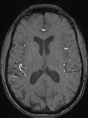Cerebral arteriovenous malformation with hemorrhage (Radiopaedia 34422-35737 Axial MRA 47).png