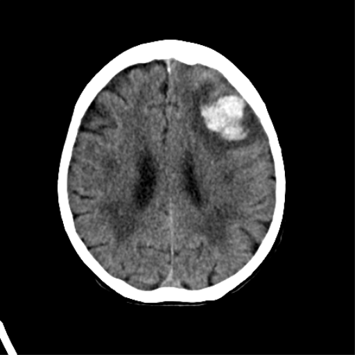 File:Cerebral arteriovenous malformation with lobar hemorrhage (Radiopaedia 44725-48510 Axial non-contrast 27).png