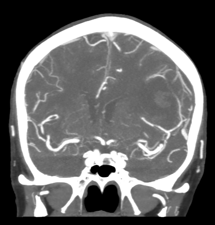 File:Cerebral arteriovenous malformation with lobar hemorrhage (Radiopaedia 44725-48511 B 24).png