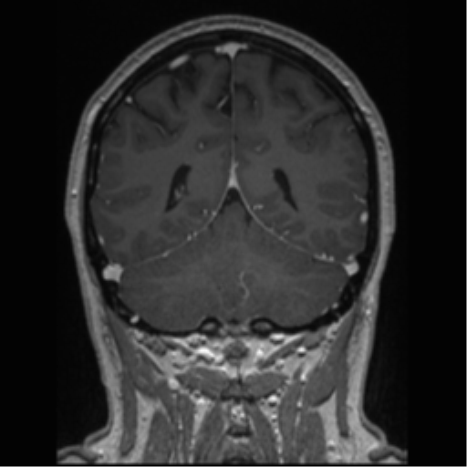 Cerebral cavernoma and development venous anomaly (Radiopaedia 37603-39482 Coronal T1 C+ 31).png