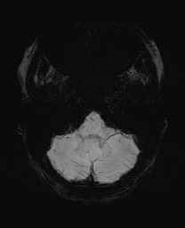 Cerebral cavernous venous malformation (Radiopaedia 70008-80021 Axial SWI 9).jpg