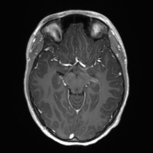 Cerebral cavernous venous malformation (Radiopaedia 70008-80021 Axial T1 C+ 29).jpg