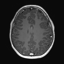 Cerebral cavernous venous malformation (Radiopaedia 70008-80021 Axial T1 C+ 59).jpg