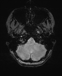 Cerebral cavernous venous malformation (Radiopaedia 70008-80021 I 9).jpg