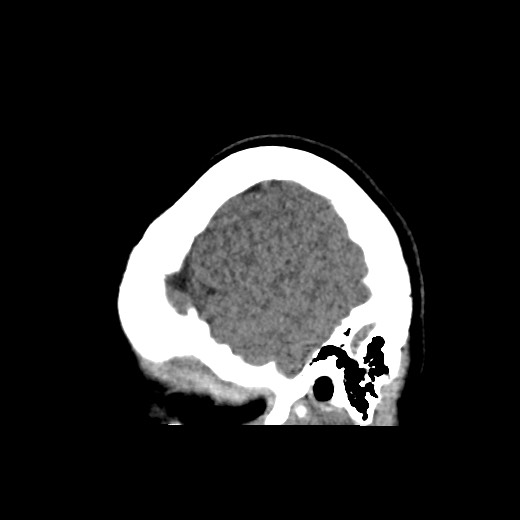Cerebral cavernous venous malformation (Radiopaedia 70008-80022 C 51).jpg