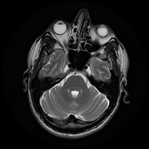 File:Cerebral cavernous venous malformation (Zabramski type II) (Radiopaedia 85511-101198 Axial T2 10).jpg