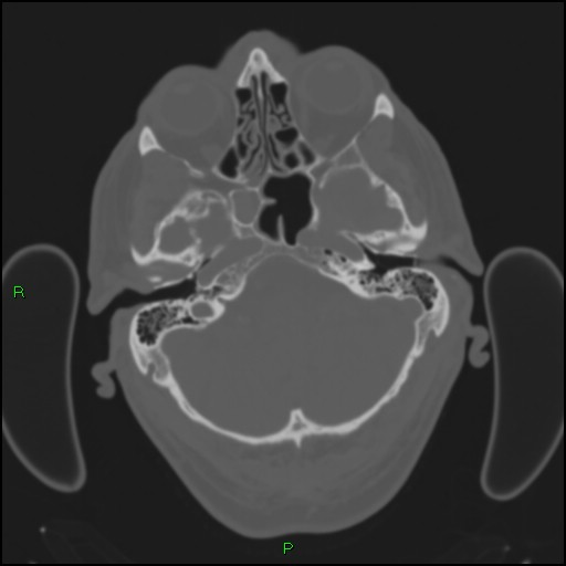 Cerebral contusions (Radiopaedia 33868-35039 Axial bone window 37).jpg