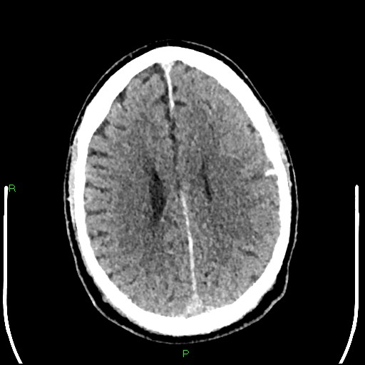 Cerebral contusions (Radiopaedia 33868-35039 Axial non-contrast 145).jpg