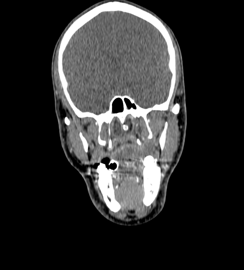 Cerebral edema in an overdose patient (Radiopaedia 72005-82539 B 6).jpg
