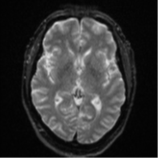 File:Cerebral embolic infarcts (embolic shower) (Radiopaedia 57395-64342 Axial DWI 18).png