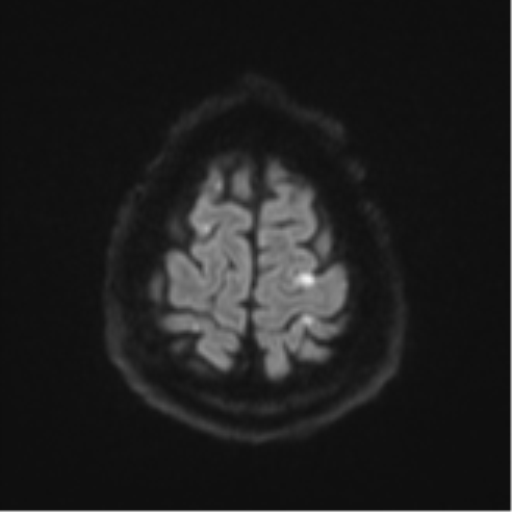 Cerebral embolic infarcts (embolic shower) (Radiopaedia 57395-64342 Axial DWI 68).png