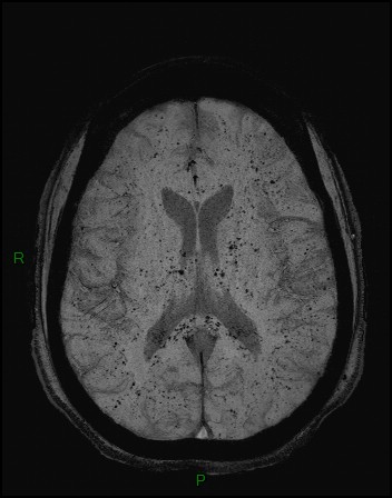 Cerebral fat embolism (Radiopaedia 35022-36525 Axial SWI 25).jpg