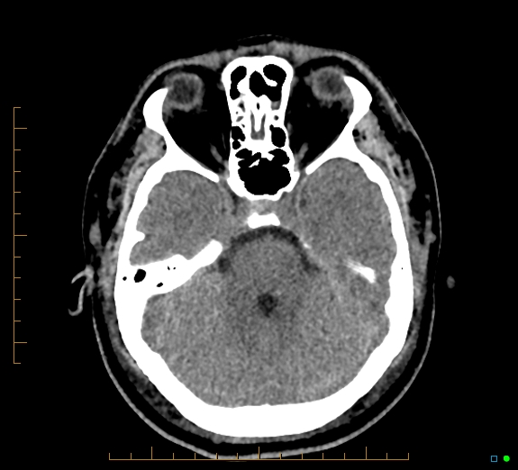 File:Cerebral fat embolism (Radiopaedia 85521-101224 Axial non-contrast 16).jpg