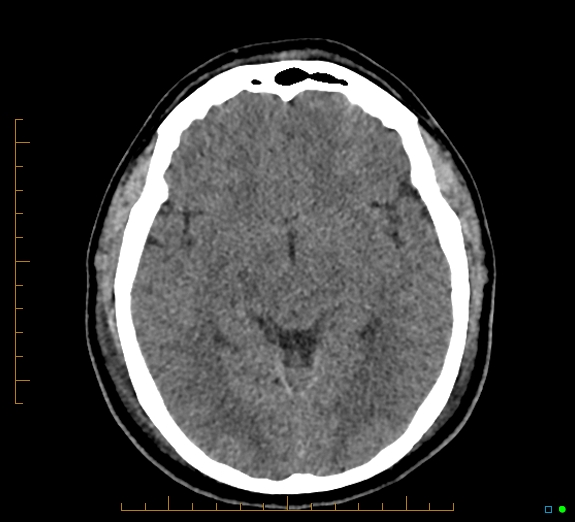 Cerebral fat embolism (Radiopaedia 85521-101224 Axial non-contrast 23).jpg