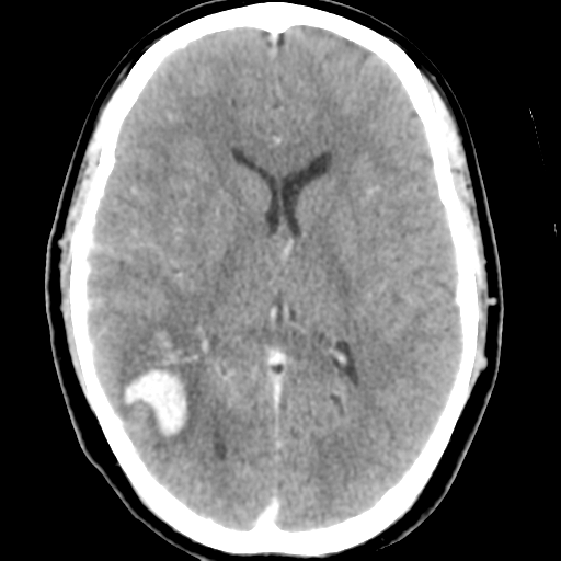 Cerebral hemorrhage secondary to arteriovenous malformation (Radiopaedia 33497-34561 B 29).png