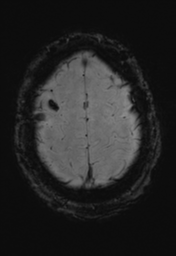 File:Cerebral hemorrhagic contusions- temporal evolution (Radiopaedia 40224-42757 D 34).png