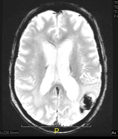 File:Cerebral metastases (Radiopaedia 17242-16946 Axial Gradient Echo 1).jpg