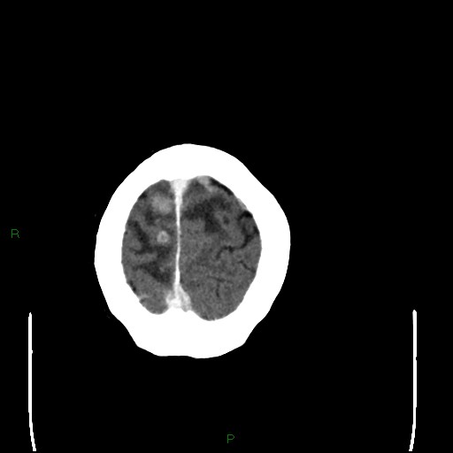 Cerebral metastases - breast primary (Radiopaedia 77653-89857 Axial C+ delayed 105).jpg
