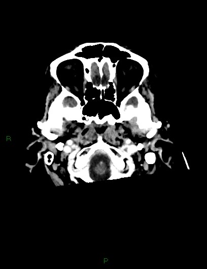 Cerebral metastases - ependymal and parenchymal (Radiopaedia 79877-93131 Axial C+ delayed 6).jpg