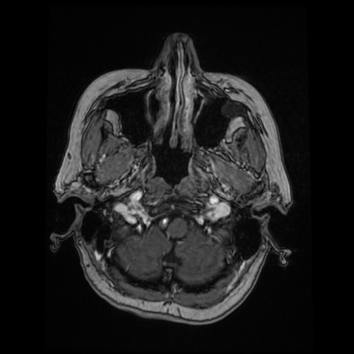 File:Cerebral metastases - melanoma (Radiopaedia 80972-94522 Axial T1 C+ 27).jpg