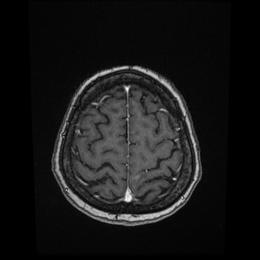 Cerebral metastases - melanoma (Radiopaedia 80972-94522 Axial T1 C+ 78).jpg