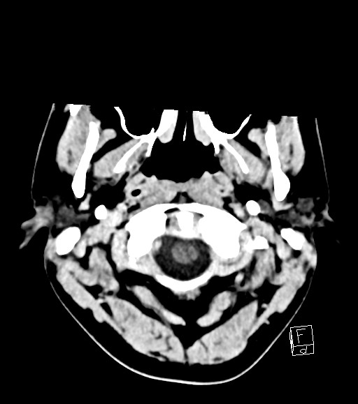 Cerebral metastases - testicular choriocarcinoma (Radiopaedia 84486-99855 Axial C+ delayed 52).jpg