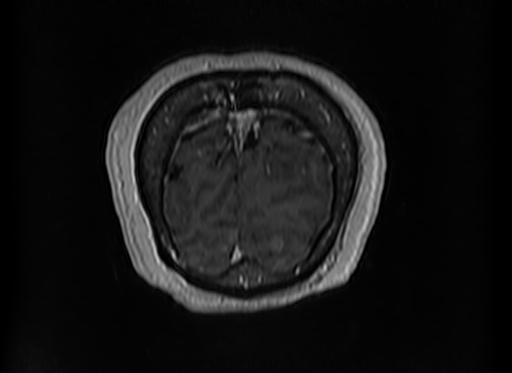 Cerebral metastases from lung cancer with amyloid angiopathy and cerebellopontine angle meningioma (Radiopaedia 74306-85191 Coronal T1 C+ 58).jpg