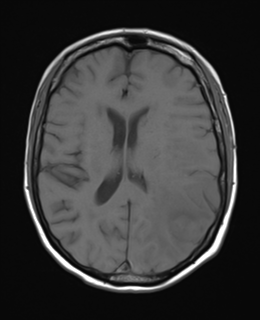 File:Cerebral metastasis (Radiopaedia 46744-51248 Axial T1 16).png