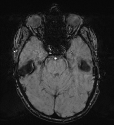 File:Cerebral metastasis - melanoma (Radiopaedia 54718-60954 Axial SWI 18).png