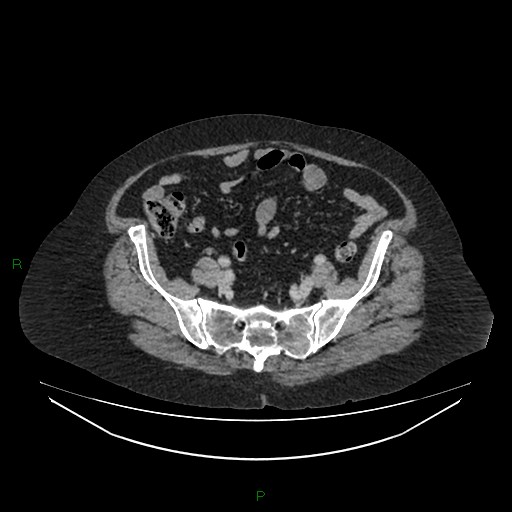 Cerebral metastasis from renal cell carcinoma (Radiopaedia 82306-96378 A 142).jpg