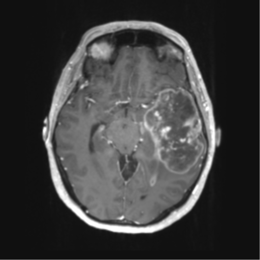 Cerebral metastasis mimicking glioblastoma (Radiopaedia 69155-78937 Axial T1 C+ 26).png