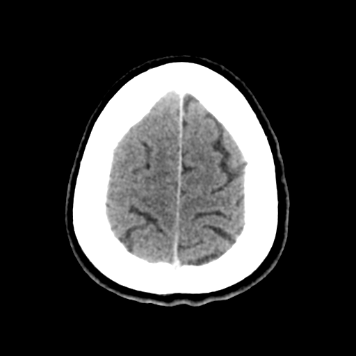 Cerebral metastasis to basal ganglia (Radiopaedia 81568-95412 Axial C+ delayed 49).png