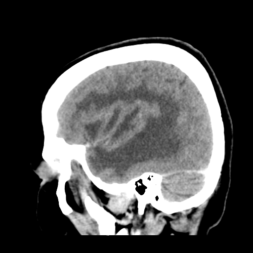 Cerebral metastasis to basal ganglia (Radiopaedia 81568-95412 Sagittal C+ delayed 15).png