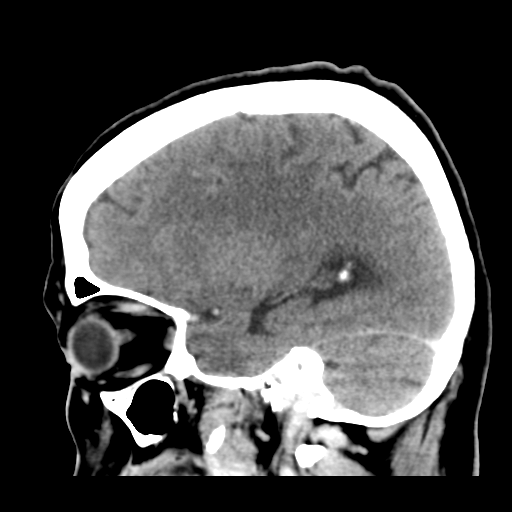 File:Cerebral metastasis to basal ganglia (Radiopaedia 81568-95412 Sagittal C+ delayed 40).png
