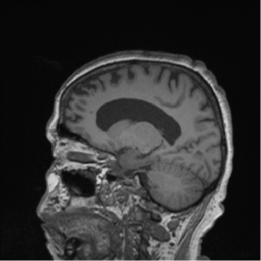 Cerebral metastasis to basal ganglia (Radiopaedia 81568-95413 Sagittal T1 27).png