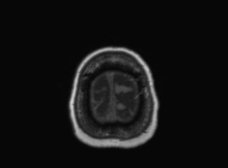 Cerebral ring enhancing lesions - cerebral metastases (Radiopaedia 44922-48817 Axial T1 108).jpg