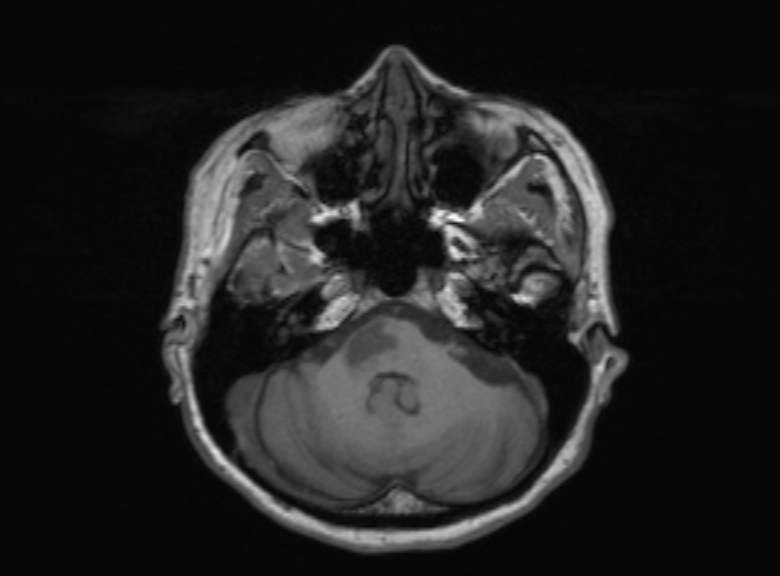 Cerebral ring enhancing lesions - cerebral metastases (Radiopaedia 44922-48817 Axial T1 303).jpg