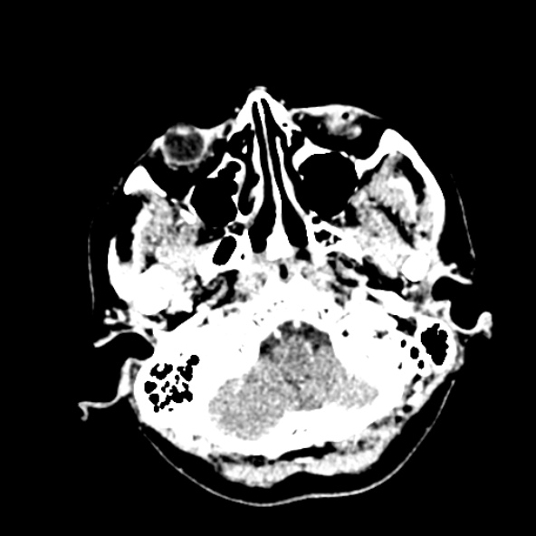 Cerebral ring enhancing lesions - cerebral metastases (Radiopaedia 44922-48818 B 41).jpg