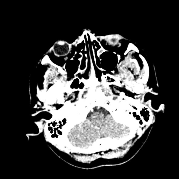 File:Cerebral ring enhancing lesions - cerebral metastases (Radiopaedia 44922-48818 B 44).jpg