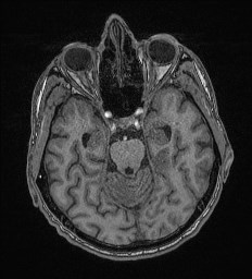 File:Cerebral toxoplasmosis (Radiopaedia 43956-47461 Axial T1 26).jpg
