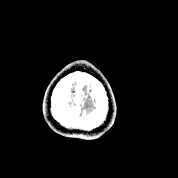 Cerebral toxoplasmosis (Radiopaedia 53993-60131 Axial C+ delayed 71).jpg