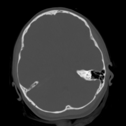 Cerebral tuberculosis with dural sinus invasion (Radiopaedia 60353-68018 Axial bone window 18).jpg