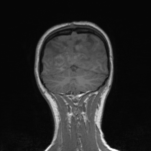 Cerebral tuberculosis with dural sinus invasion (Radiopaedia 60353-68090 Coronal T1 148).jpg