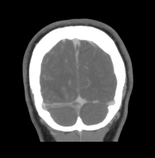 Cerebral venous hemorrhagic infarction (Radiopaedia 38461-40550 Coronal MIP VENOGRAM 52).png