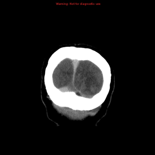 Cerebral venous infarction (Radiopaedia 12404-20735 B 78).jpg