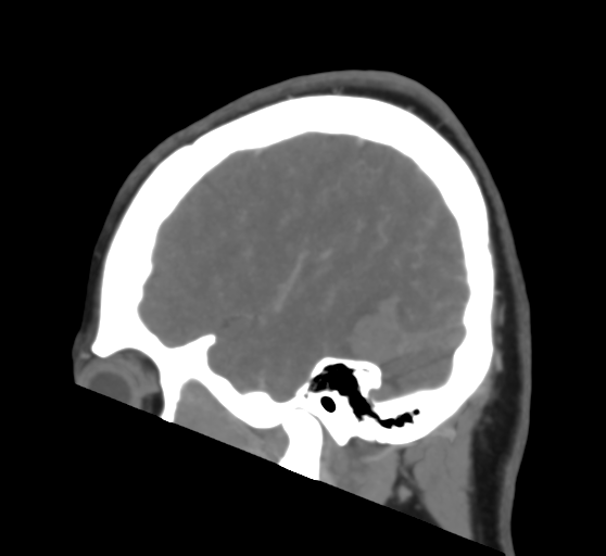 File:Cerebral venous infarction due to transverse sinus thrombosis (Radiopaedia 34688-36120 Sagittal CT venogram 14).png