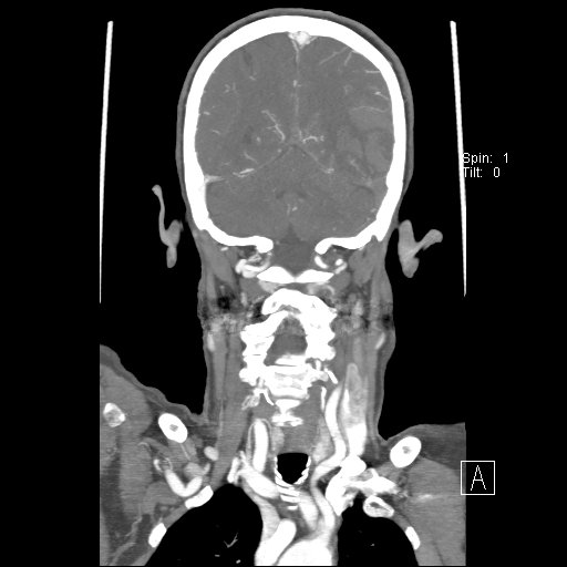 Cerebral venous infarction with hemorrhage (Radiopaedia 65343-74396 B 203).jpg