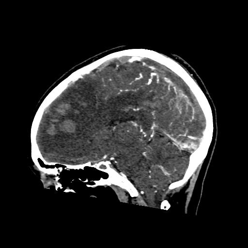 File:Cerebral venous throbmosis - hemorrhagic venous infarction (Radiopaedia 87318-103613 Sagittal CT venogram 25).jpg
