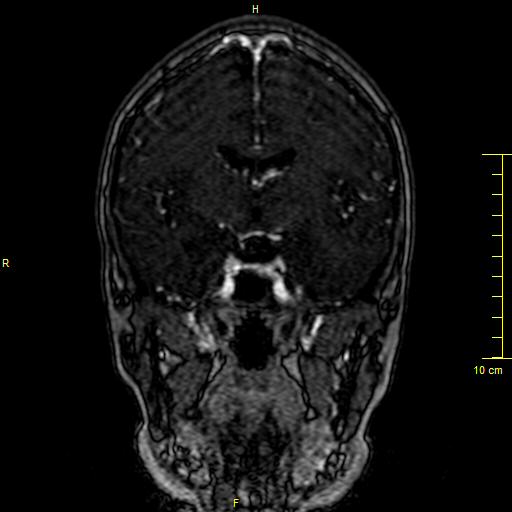 Cerebral venous thrombosis (Radiopaedia 23288-23351 MRV 66).JPG